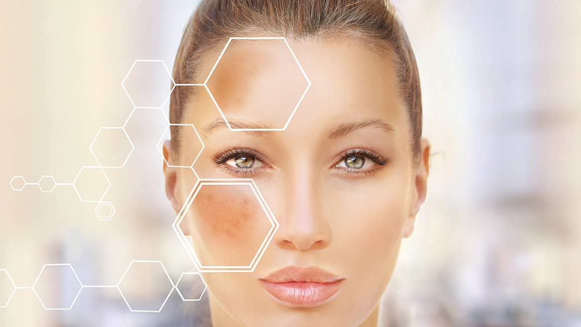 Hyperpigmentation3