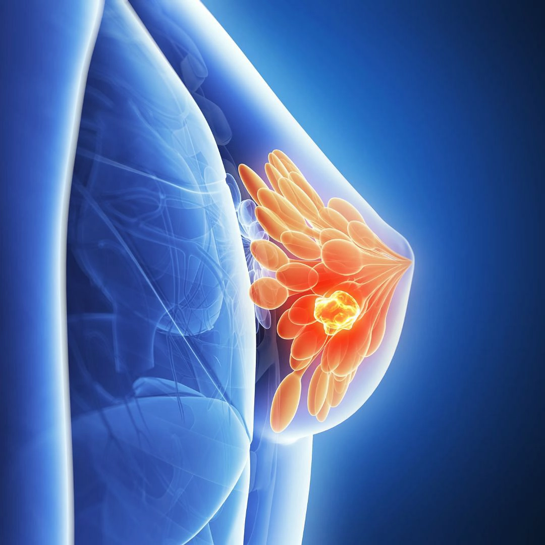 Breast Cancer