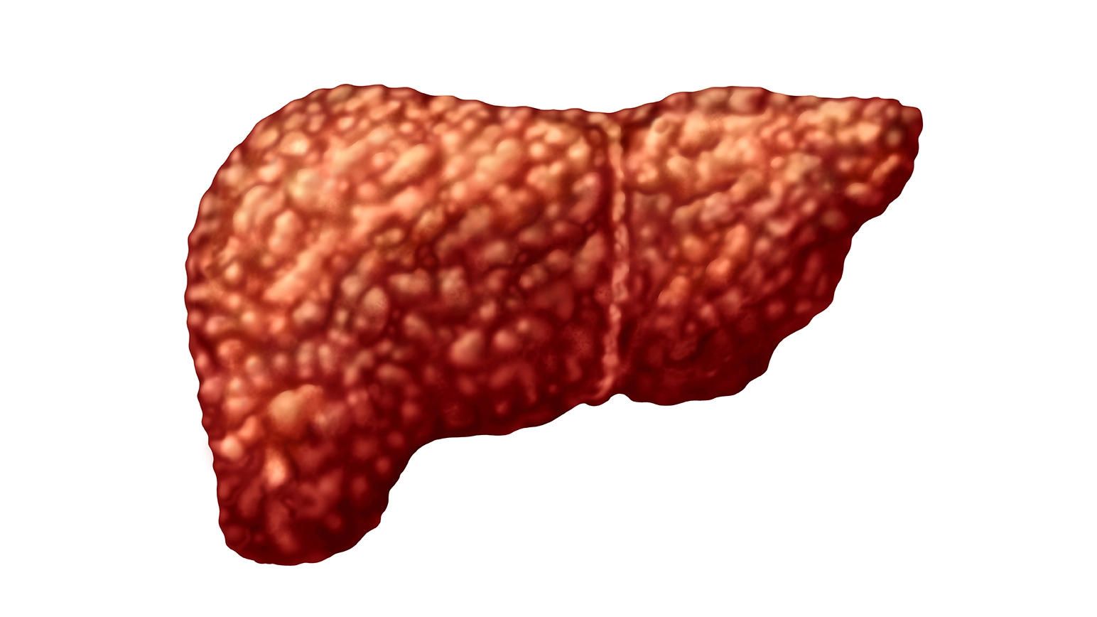 hepatic steatosis